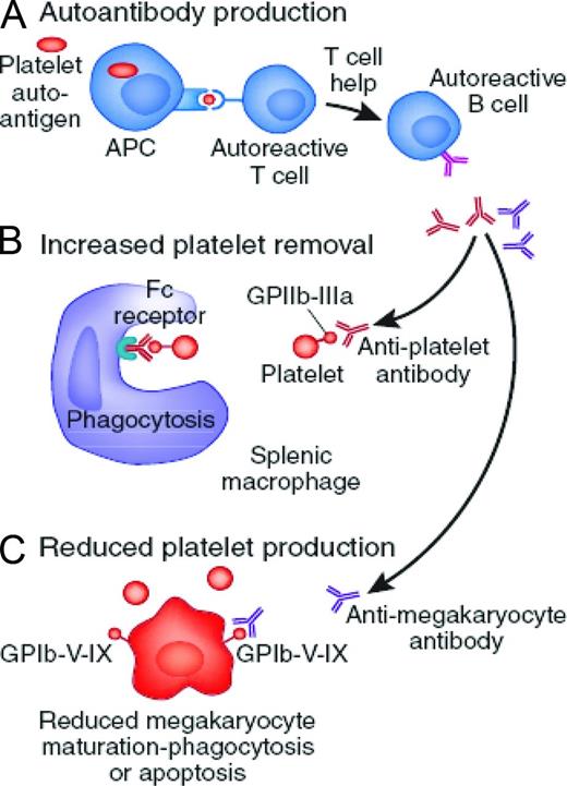 Figure 1. Proposed mechanism of immune dysregulation in ITP. (A) T cells are activated upon recognition of platelet-specific antigens on the APCs and therefore induce antigen-specific expansion of B cells. The B cells in turn produce autoantibodies with specificity for glycoproteins expressed on platelets and megakaryocytes. (B) Circulating platelets bound by autoantibody are removed by Fc receptors predominantly by splenic macrophages. (C) Autoantibodies also reduce the capacity of megakaryocytes to produce platelets. Adapted with permission from Wei and Jackson.8