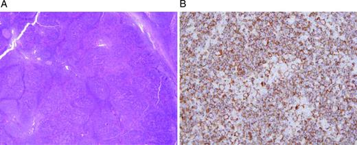 Figure 1. NLPHL key pathologic features. (A) Magnification of 20× showing the nodular formation. (B) Magnification of 400× with staining for CD20 highlighting L&H cells in a background of reactive lymphocytes and histiocytes. Images courtesy of Jeffrey Medeiros, MD, University of Texas MD Anderson Cancer Center.