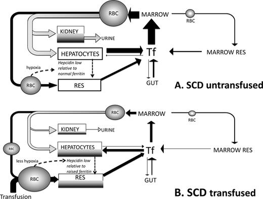 Figure 1. Summary of differences in iron turnover in SCD triggered by transfusion. This scheme is devised by the authors and builds upon current understandings from work by us and others.16,23,29 (A) Iron turnover in SCD in the absence of blood transfusion is shown. Arrows denote iron fluxes involved in RBC formation in the BM from plasma transferrin pool (Tf) and destruction in RES macrophages (black) or through intravascular hemolysis (grey). Intravascular hemolysis forms a significant proportion of iron turnover directed to liver via hemopexin and haptoglobin binding of heme and hemoglobin, respectively. These mechanisms are nearly always saturated in SCD with a large proportion of free Hb available for glomerular filtration and renal uptake (via megalin and cubulin) leading to renal iron redistribution and urinary loss. IE in SCD is small relative to TM and effective erythropoiesis in SCD, so that BM is less expanded and IE iron reflux smaller than in TM, whereas iron absorption from the gut is not as increased through suppression of hepcidin. Hepatocytes and RES have low iron stores despite high rate of iron entry (as heme, Hb, or RBC) due to unopposed iron exit via ferroportin secondary to low hepcidin50 and to heme-dependent up-regulation of ferroportin transcription.32 Hypoxia and high rate of erythropoiesis reduce hepcidin51 despite chronic inflammatory state,52 leading to relative hepcidin deficiency (low hepcidin/ferritin ratios) that facilitates iron egress from RES and hepatocytes. Urinary loss may be greater than intestinal absorption, leading to iron deficiency in a high proportion of nontransfused SCD patients. (B) Iron turnover in a transfused SCD patient is shown. Replacement of sickle RBCs with transfused RBCs decreases intravascular hemolysis (grey) and hence decreases iron clearance through hemopexin and haptoglobin by the liver and leaves less free Hb available for kidney uptake and urinary loss. Erythropoiesis of sickle RBCs is also suppressed if that transfusion regime increases the Hb. A greater proportion of iron turnover is through extravascular RBC destruction, which is subsequently directed via Tf to BM and hepatocytes. Increased Hb values after transfusion decrease erythropoiesis and transferrin iron clearance in BM: a greater proportion of transferrin iron is directed to hepatocytes which store increased iron (shown in dark grey). RES iron is also increased by greater erythrophagocytosis of transfused RBCs and increased hepcidin synthesis in hepatocytes (less hypoxia and lower erythropoietic rate). Tf saturation increases relative to nontransfused SCD, but rarely to the levels seen in TM and typically without NTBI formation. Continued hemolysis of remaining sickle RBCs continues to route heme iron away from the erythrophagocytosis-transferrin circuit to hepatocyte and kidney so that Tf saturation does not increase as much as in nonhemolytic conditions despite reduced erythroid uptake.