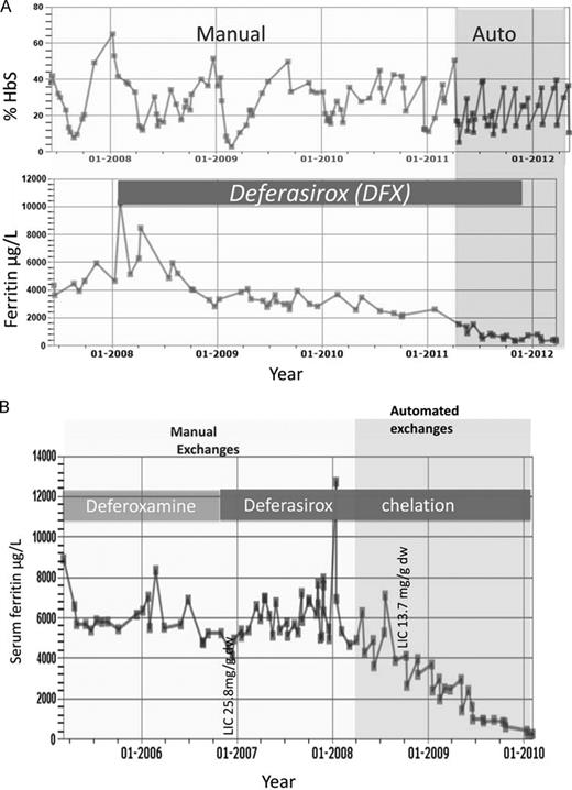 Figure 3. Effect of switching to automated exchanges and use of DFX in iron load in SCD for 2 patients treated at University College London Hospitals. (A) The effect of changing from manual exchanges (light shading) to automated RBC exchange (darker shading) is shown in an adult patient with SCD who remained on DFX throughout the period of observation until SF values approached normal levels. The %HbS is maintained < 40% more consistently with automated exchanges. Introduction of DFX lowers SF while on manual exchanges and SF values close to normal ranges are achieved after switching to automated exchanges. (B) Effect on SF of switching from DFO to DFX is shown, followed by the effect of switching from manual (light shading) to automated exchanges (darker shading). SF remained high (> 4000 μg/L) with high LIC (25.8 mg/g dry weight) after years of DFO and manual exchanges. The trend in SF decreases toward the normal range only after introduction of DFX and automated exchange.
