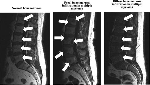 Figure 2. MRI of the BM in healthy controls and in patients with multiple myeloma.