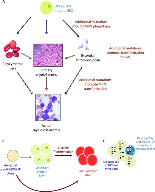 Figure 1. Evidence for somatic mutations in genes other than those activating JAK-STAT signaling in MPN patients. (A) Given that JAK2V617F mutations are common to 3 MPN disorders with distinct phenotypes (PV, ET, and PMF), it has been postulated that additional somatic or germline variants might contribute to the MPNs produced. In addition, mutations in genes outside of JAK2V617F are thought to play a role in transformation of PV and ET to PMF and in the transformation of chronic MPNs to AML. (B) Since the discovery of the JAK2V617F mutation, it was noted that patients with JAK2 mutant chronic MPN may undergo transformation to a JAK2 wild-type AML. This observation suggests that the JAK2V617F mutation may not be required for leukemic transformation or that a clone ancestral to the JAK2V617F mutant cell was subject to leukemic transformation. (C) Finally, it has also been observed that occasional patients with the JAK2V617F mutation in addition to a cytogenetic alteration (illustrated here by deletion 20q) may have the JAK2 mutation in only a portion of the MPN clones, whereas the majority of the MPN cells bear both the cytogenetic alteration and the JAK2 mutation. This finding again suggests that the JAK2V617F mutation may not be the initiating genetic event in MPN pathogenesis.