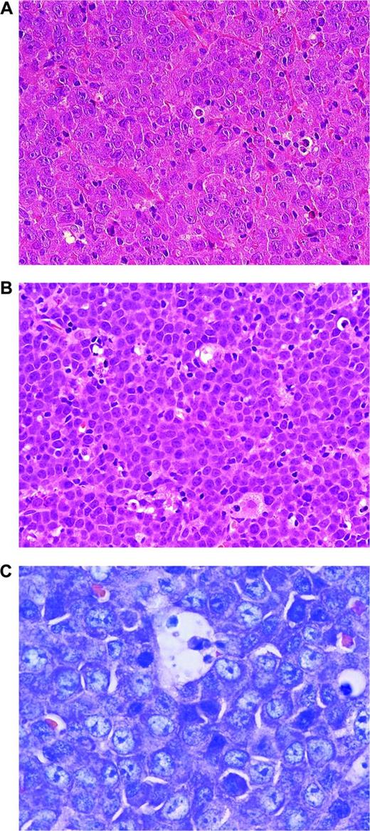 Figure 3. Aggressive lymphomas with MYC translocations. (A) MYC-rearranged DLBCL. Note large blastic cells with broad cytoplasm and large nuclei, finely dispersed nuclear chromatin, and single prominent nucleoli (H&E stain; magnification, 400×). (B) BCLU. In comparison with BL, the tumor cells are slightly larger and harbor more irregular nuclei, sometimes with single nucleoli. Some histiocytes are interspersed, but there is no clearcut starry sky pattern (H&E stain; magnification, 400×). (C) PBL MYC rearranged. The cells are small to intermediate in size. Giemsa stain highlights the plasmablastic features of the tumor cells. CD20 was negative in this tumor (magnification, 1000×).