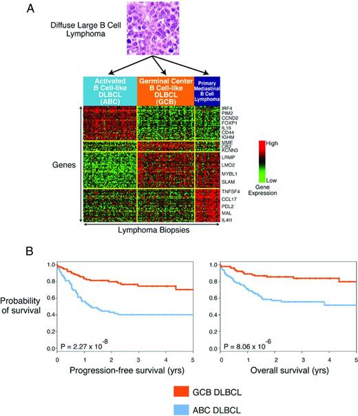 Figure 1. Diagnosis and outcome of DLBCL subtypes by GEP. (A) Heat map showing differential expression of genes in GCB, ABC, and PMBL DLBCL subtypes. (B) Kaplan-Meier estimates of progression-free and overall survival are shown according to GCB or ABC DLBCL subtype in patients treated with R-CHOP–based therapy. Median follow-up is approximately 2 years.