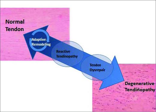 Figure 1. The continuum of tendinopathy.