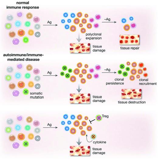 Figure 1. Somatic mutations in lymphocytes might drive an aberrant immune response. Tissue damage is a normal component of an inflammatory response and resolves with withdrawal of the stimulating antigen. Acquired mutations, altering proliferation, susceptibility to apoptosis, or a variety of signaling pathways in an effector population or in regulatory cells would lead to persistence of a clone, tissue destruction, exposure of new antigens, and further recruitment of immune cells.