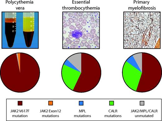 Figure 1. Frequency of JAK2, CALR, and MPL mutations in PV, ET, and MF. JAK2 mutations are found in 97% of patients with PV and in 50%–60% of those with ET and MF. CALR mutations are the next most frequent genetic aberration, affecting 1/3 of patients with ET or MF. MPL mutations are found in 3%–10% of ET or MF patients. JAK2, MPL, and CALR mutations are mutually exclusive in the majority of patients. Ten to fifteen percent of ET and MF cases have no common underlying genetic marker.