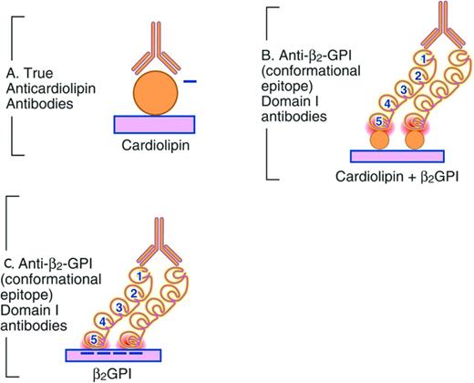 Figure 2. Representation of APS autoantibody binding. (A) aCL assay. Shown is the autoantibody (Y) binding negatively charged (−) phospholipid. (B) β2GPI-dependent aCL assay. Shown is the autoantibody binding to domain I of β2GPI. β2GPI domains are denoted by the numbers 1-5. (C) Anti-β2GPI domain I assay.