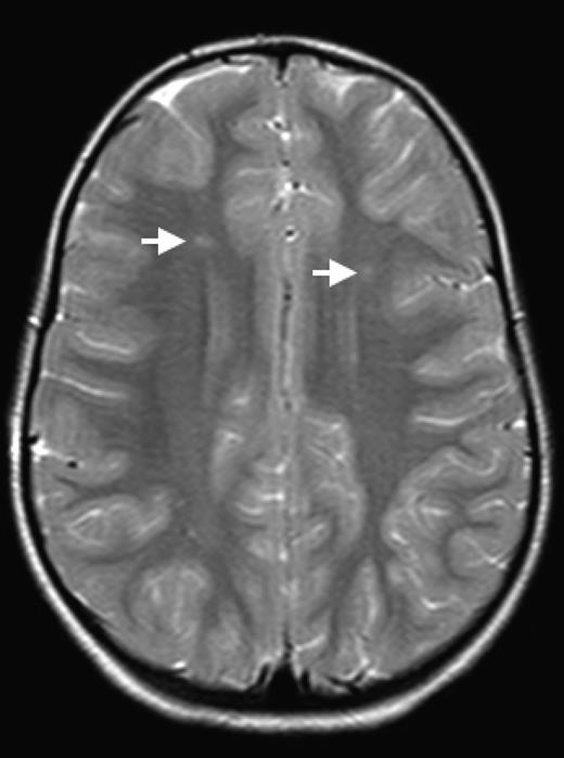 Figure 1. SCI. Two typical SCI lesions (arrows) are shown in the frontal and deep white matter in a T2-weighted magnetic resonance image of the brain in a child with sickle cell anemia.