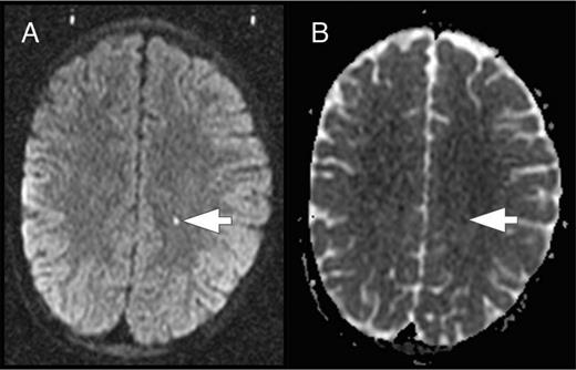 Figure 5. ASCIE. ASCIE is defined as an area of restricted diffusion on DWI sequences (A) with a corresponding decrease in signal intensity on the apparent diffusivity coefficient (ADC) map (B) in the absence of focal neurologic findings that could be explained by the location of the DWI-positive lesion. The lesion has increased signal on T2 and T2-fluid-attenuated inversion recovery images (data not shown).