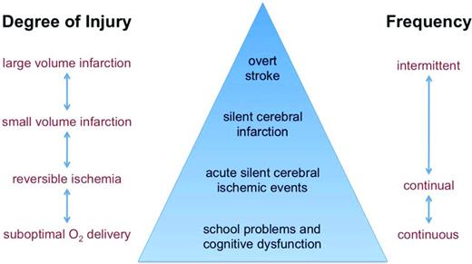 Figure 6. Model depiction of different type of brain injury or dysfunction in SCD. Types of brain injury are shown in the triangle and categorized by degree of injury and frequency. Overt stroke and SCI likely represent only a fraction of the burden of ischemic insults to the brain.