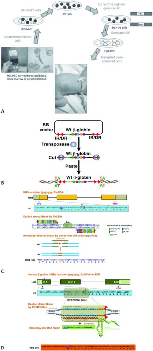Figure 4. Development of SCD patients. (A) Studies deriving gene-corrected HSCs using human cell lines obtained from patients with SCD to generate iPS cells, with the ultimate goal of autologous transplantation. Reprinted with permission from Freed et al, 2012.21 (B) Sleeping Beauty (SB) transposon and transposase mediated wild-type (Wt) β-globin gene integration. (C) Transcription activator-like effector nucleases (TALENs)-mediated human beta-globin (HBB) gene correction in SCD. (D) The clustered regularly interspaced short palindromic repeats (CRISPR)/CRISPR-associated (Cas)-mediated human β-globin (HBB) gene correction in SCD.