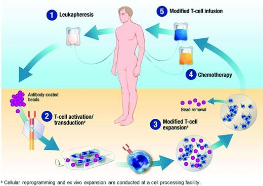Figure 2. Manufacture of CAR-modified T cells. Peripheral blood mononuclear cells collected by leukapheresis are expanded ex vivo and transduced to express the CAR molecule before infusion into the patient. In this example, magnetic beads coated with antibodies to CD3 and CD28 are used for ex vivo expansion.40 (Image used with permission from Novartis Pharmaceuticals. Copyright 2014, Novartis Corporation.)