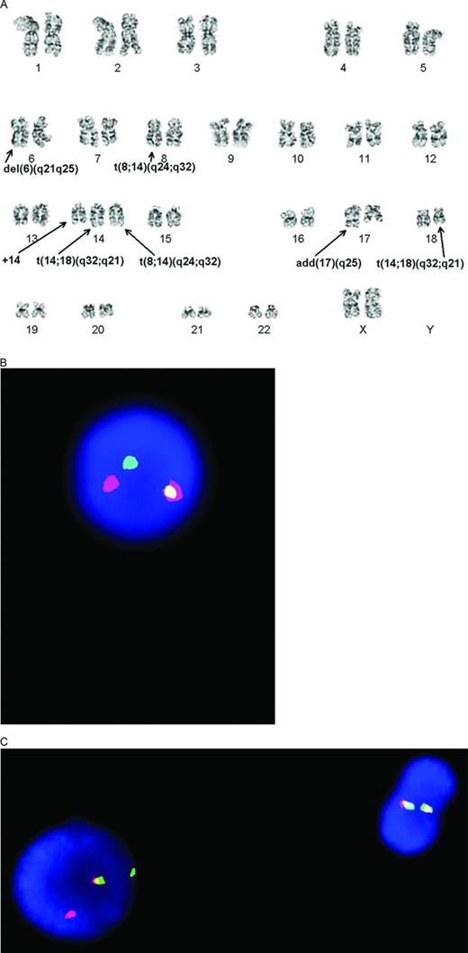 Figure 1. Cytogenetic documentation of DHL. (A) Classical cytogenetics shows a complex karyotype with presumptive MYC/IGH and BCL2/IGH translocations. (B) The MYC translocation is confirmed with interphase FISH studies using a break-apart probe that shows one normal fused signal and one set of separated red and green signals. (C) The BCL2 translocation is confirmed with interphase FISH studies using a break-apart probe. There is one normal cell on the right with 2 fused signals and an abnormal cell with 1 fused and 1 set of separated red and green signals. (Figure contributed by U. Surti and M. Sherer.)