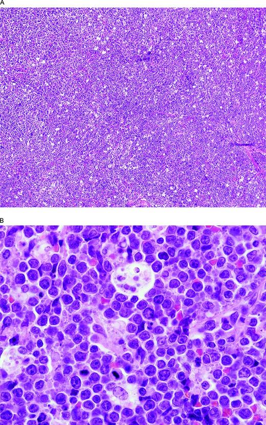 Figure 2. BCLU with MYC and BCL6 double-hit. (A) There is a diffuse proliferation with a starry sky pattern due to tingible body macrophages like in a BL. (B) At high magnification, note the rather monotonous proliferation of intermediate-size transformed cells and scattered tingible body macrophages. Although resembling a BL, there are more cells with single central nucleoli than would be typical and some irregular nuclear contours. The Ki-67 stain was extremely high but, unlike BL, the cells were CD10 negative and BCL2 positive (not illustrated).