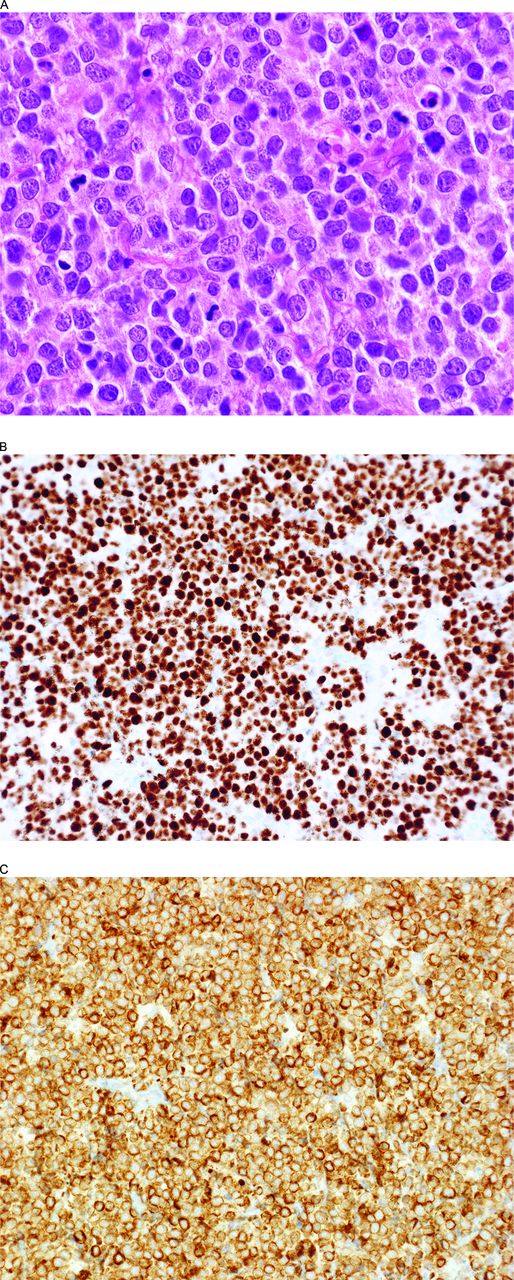 Figure 3. BCLU with MYC and BCL2 double-hit and MYC and BCL2 expression (DE). (A) This lymphoma has somewhat blastoid nuclei and a high mitotic rate. Note the extensive nuclear MYC (B) and cytoplasmic BCL2 (C) expression fulfilling the criteria for a DE B-cell lymphoma. The lymphoma had a GC-type phenotype (CD10+, BCL6+, IRF4/MUM1−) and >95% Ki-67-positive cells (not illustrated).