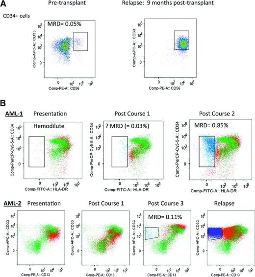 Figure 2. Examples of detecting MRD with “different-from-normal approach” applied to myeloblast population. (A) AML patient undergoing allogeneic stem cell transplant with no prior flow cytometric data available to identify diagnostic LAIP; however, pretransplant bone marrow CD34+ myeloblasts (defined by gating using CD34+/CD117+/CD45/SSC/FSC parameters) include a clearly aberrant CD34+CD33+CD56+ leukemic population and therefore are MRD-positive (0.05% of BM-nucleated cells). This patient relapsed with the same aberrant phenotype. (B) Examples of 2 AML patients (AML-1, AML-2) monitored for MRD during chemotherapy using data overlay with a control sample to detect “different-from-normal” blast subpopulations in CD117+ myeloblasts (defined by gating using CD117+/CD45/ SSC/FSC parameters). Green, CD117+ myeloblasts of control bone marrow; red, CD117+ myeloblasts of patient's bone marrow; blue, emerging aberrant leukemic subpopulation within empty space; empty space, region in which there are very few or no normal cells. (AML-1) CD34 vs HLADR plots shown of CD117+ blasts. Presentation sample was hemodilute with no definite LAIP (other markers not shown). Postcourse 1 sample had a small number of cells in an empty space (CD34+HLADRlow, in blue) but categorized as insufficient to define as MRD without a diagnostic LAIP; however, the postcourse 2 sample had obvious MRD within the same empty space. (AML-2) CD33 vs CD13 plot shown of CD117+ blasts. Change in leukemic immunophenotype with MRD postcourse 3 from an emerging new aberrant subpopulation in an empty space (CD33+CD13low, in blue). This patient relapsed with the same aberrant phenotype but the diagnostic LAIPs were not present (including from other markers not shown).