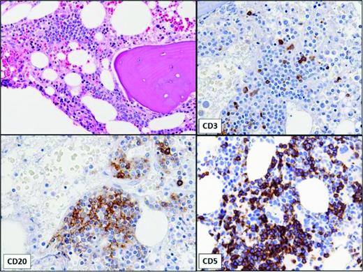 Figure 1. Bone marrow showing small, non-paratrabecular lymphoid aggregate in a patient with a very small B-cell clone with a CLL-like immunophenotype identified by flow cytometry of aspirate. No peripheral lymphocytosis was present. The immunohistochemical stains show that the aggregate is composed of a mixture of CD20+, CD5+ B lymphocytes and CD3+ T lymphocytes.