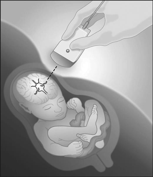 Figure 1. Diagram of fetal middle cerebral artery Doppler velocimetry testing. Adapted from Moise42 with permission.