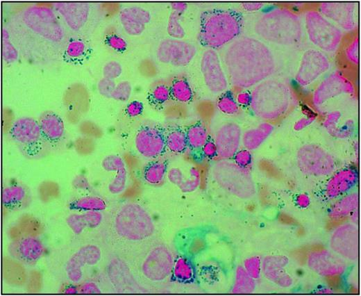 Figure 1. Bone marrow smear from a patient with RARS. Perls staining shows that most erythroblasts have positive granules disposed in a ring surrounding the nucleus, that is, the typical pattern of ring sideroblasts. Magnification, 1250.