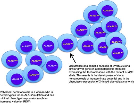 Figure 2. A link between inherited and somatic mutations in the pathogenesis of sideroblastic anemia. Schematic representation of the process that may lead to the phenotypic expression of XLSA in a woman who is heterozygous for an ALAS2 mutation. ALAS2WT indicates wild-type allele; ALAS2Mut, mutant allele. The development of age-associated clonal hematopoiesis—in this example caused by the occurrence of a somatic mutation of DNMT3A—may lead to the selective expansion of a hematopoietic stem cell that expresses the X chromosome carrying the mutant ALAS2 allele. This would in turn lead to the phenotypic expression of XLSA, as happens in hemizygous males. The interaction between XLSA and clonal hematopoiesis may alter some features of XLSA, such as the MCV, which can be borderline (∼80 fL) in patients with clonal hematopoiesis rather than markedly decreased (60-70 fL) as it is in typical hemizygous males.