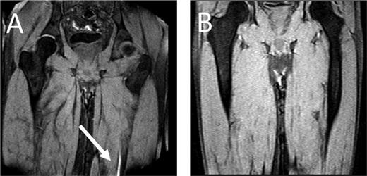 Figure 1. MRDTI of patient from case 1 (A): the white arrow indicates the fresh thrombus in the popliteal vein of the right leg. For contrast, B depicts the MRDTI of a patient with residual thrombosis in the left popliteal and femoral vein: no DTI signal is present.