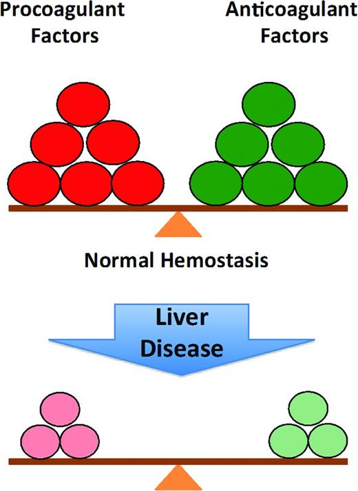 Figure 1. The normal balance of hemostasis and rebalanced hemostasis in liver disease: because of the relative deficiency of both procoagulant and anticoagulant factors in chronic liver disease, the balance is more fragile and more easily tipped toward bleeding or thrombosis.