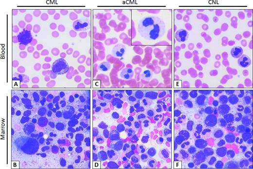 Figure 1. Typical smear of blood and marrow aspirate in CML, aCML, and CNL. (A) CML peripheral blood smear. Morphologically unremarkable neutrophils with frequent immature granulocytes, including a disproportionally high percentage of myelocytes. Basophilia, thrombocytosis, and eosinophilia are also common. (B) Aspirate smear. Myeloid hyperplasia without overt granulocytic dysplasia, frequent myelocytes (so-called “myelocyte bulge”) and marrow eosinophilia. Note the micromegakaryocyte or “dwarf megakaryocyte” in the lower left-corner. (C) aCML peripheral blood smear. Frequent dysplastic neutrophils; note the dysplastic morphologic features including hypogranularity and hypolobation (pseudo-Pelger–Huët anomaly, inset). (D) aCML aspirate smear. Myeloid hyperplasia with prominent dysplasia and without basophilia/eosinophilia. (E) CNL peripheral blood smear. Neutrophilia without dysplastic forms or immature granulocytes. (F) CNL Aspirate smear. Myeloid hyperplasia without dysplastic morphologic features or basophilia/eosinophilia. Images obtained at 63×, courtesy of Dr Philipp W. Raess.