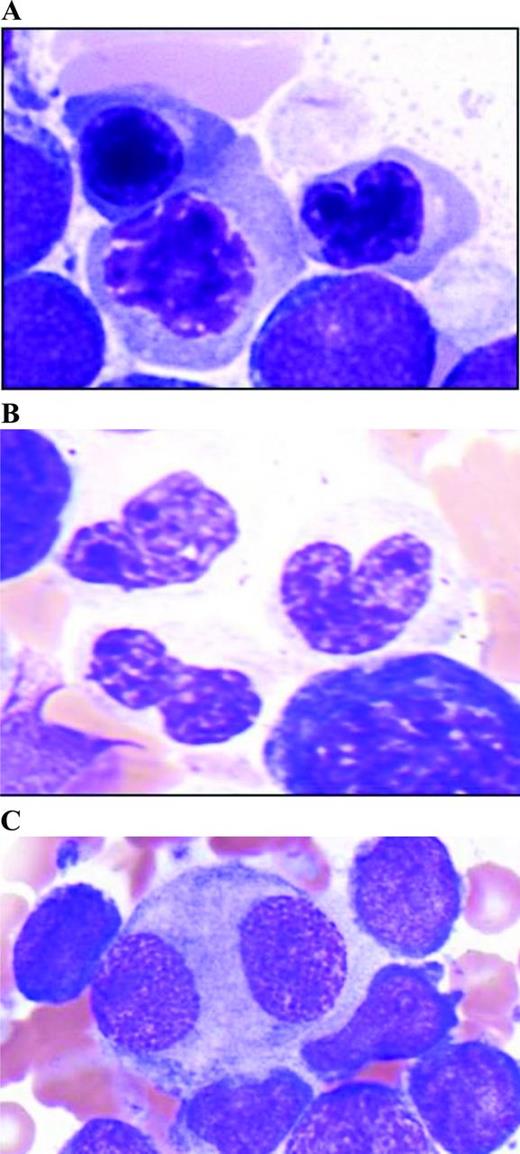 Figure 1. Morphologic features of myelodysplastic syndromes. (A) Erythroid dyspoiesis is often characterized by nuclear irregularities. (B) Hypogranularity of neutrophils with abnormal nuclear segmentation is also common. (C) Small, hypolobated megakaryocytes, small are one form of dysmegakaryopoiesis.