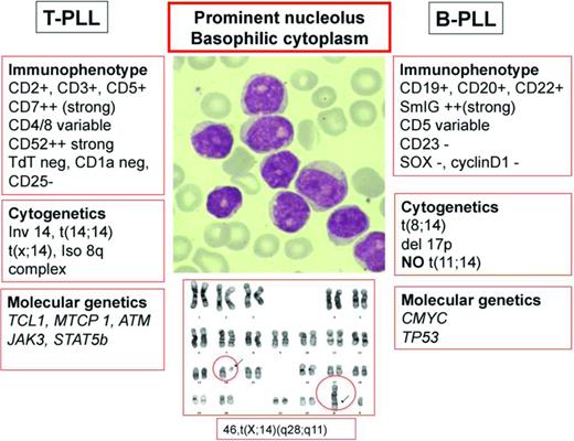 Figure 1. Integrated diagnosis of PLL showing characteristic morphology, immunophenotyping, cytogenetics, and molecular genetics for T- and B-cell subtypes.