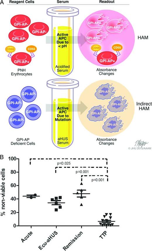 Figure 3. A) Model of Ham test for PNH (top) and indirect Ham test for aHUS diagnosis (bottom). The Ham test evaluates the effect of acidified serum on patient's cells, whereas the modified test evaluates the effect of patient's serum on GPI-anchored protein–deficient reagent cells. Both tests use absorbance changes as readouts of cell viability. GPI-AP indicates glycosylphosphatidylinositol-anchored proteins. B) WST-1 cell viability assay in patients with aHUS. Percentage of nonviable reagent cells in aHUS after exposure to acute-phase serum, remission serum on eculizumab (Ecu), and remission serum off eculizumab compared with acute or remission serum from TTP patients.