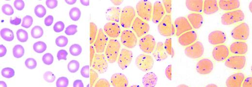 Figure 1. Unstable hemoglobins: peripheral blood smear and Heinz body preparation. Peripheral smear (left) shows “bite” cells with pitted-out semicircular areas of the red blood cell membrane as a result of removal of Heinz bodies by macrophages in the spleen. The Heinz body preparation (middle) shows increased Heinz bodies in the same specimen compared with a control (right). Reproduced with permission from Benz and Ebert.41