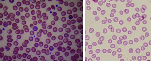Figure 4. Peripheral blood smears in altered volume homeostasis. (Left) Hereditary xerocytosis. (Right) Hereditary hydrocytosis. (Left) A Wright-stained peripheral blood smear from a patient with hereditary xerocytosis due to a PIEZO1 mutation showing rare stomatocytes, occasional dessicytes–dense, abnormal erythrocyte forms where hemoglobin appears puddled at the periphery, and rare target cells. (Right) A Wright-stained peripheral blood smear from a patient with hereditary hydrocytosis is shown. Numerous stomatocytes, erythrocytes with a central mouth-like “stoma” are seen.