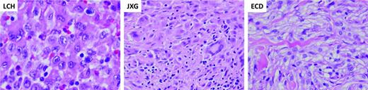 Figure 1. Characteristic histology of histiocytic lesions. Diagnostic biopsy specimens of LCH, JXD, and ECD lesions stained with hematoxylin and eosin. The LCH biopsy demonstrates characteristic clusters of histiocytes with reniform nuclei. The background inflammatory infiltrate includes lymphocytes, eosinophils, and macrophages. The JXG biopsy demonstrates characteristic xanthomatous histiocytes along with multinucleated Touton giant cells. The ECD biopsy is similar to JXG, also wth xanthomatous histiocytes and inflammatory infiltrate. (Images courtesy of Dr M. John Hicks, Baylor College of Medicine.)