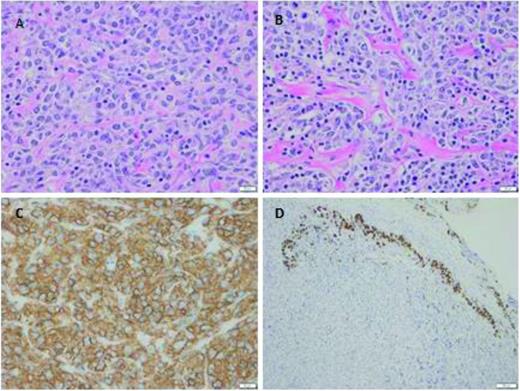 Figure 1. Primary mediastinal large B-cell lymphoma (photos courtesy of Andrew Evans, Department of Pathology, University of Rochester, Rochester, NY). The tumor was a 5.2 cm isolated anterior mediastinal mass from a 23 year old female. (A-B) Tumor cells are medium-to-large in size, with round-to-irregular nuclei, open chromatin, and abundant pale cytoplasm. As commonly seen, tumor cells are infiltrating through a background of compartmentalizing alveolar or “packeted” fibrosis. (C) Membranous CD20 is abundantly and strongly expressed. (D) Remnant thymic epithelium (positive for cytokeratin) is commonly seen at the tumor edge infiltrated by malignant cells.