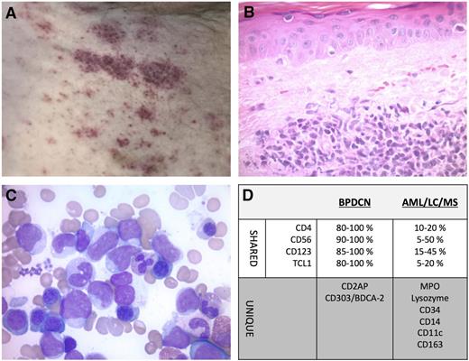 Figure 1. Morphologic evaluation and immunohistochemical markers that aid in the diagnosis of BPDCN. (A) Skin lesions of BPDCN can vary in shape, size, color, and distribution. Hyperpigmented red-brown macules, shown here, may be confused with neoplastic and nonneoplastic etiologies. (B) Skin biopsy (×500) of dermal infiltrate of immature mononuclear cells, which spares the epidermis (separated by a Grenz zone) typical of BPDCN, LC, and myeloid sarcoma (MS) and helps distinguish those diseases from mycosis fungoides which is usually epidermotropic. (C) Bone marrow aspirate (×1000) demonstrates medium to large cells with scant cytoplasm, immature chromatin, irregular nuclear contours, and prominent nucleoli. (D) Shared immunohistochemical markers are shown with a range of positive cases observed for BPDCN and AML/LC/MS. Ranges are rounded to the nearest 5% based on multiple series.2,17,18,26 Clearly the overlap of shared markers and exception of atypical cases that lack a particular marker highlight the need for review of unique markers to differentiate BPDCN from AML/LC/MS.
