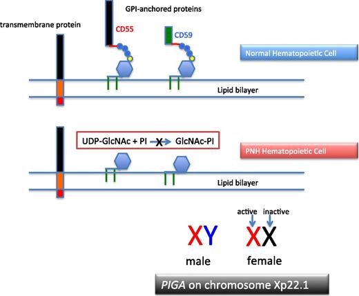 Figure 1. The molecular basis of PNH. Normal hematopoietic stem cells express both transmembrane and GPI-anchored proteins (top). PNH stem cells express transmembrane proteins normally but fail to express GPI-APs because the first step in synthesis of the anchor is inactivated because the gene (PIGA) that encodes the enzyme that is required for transfer of the nucleotide sugar (UDP-GlcNAc) to phosphatidylinositol is mutant (middle). Of the more than 25 genes involved in synthesis of the GPI anchor, only PIGA is located on the X-chromosome (all others are autosomal). Location on the X-chromosome accounts for the observation that essentially all cases of PNH are due to somatic mutation of PIGA because inactivation of only 1 allele is required to produce the PNH phenotype as males have 1 X-chromosome and in females only 1 of the 2 X-chromosomes is active in somatic tissues (bottom). UDP, uridine diphosphate.