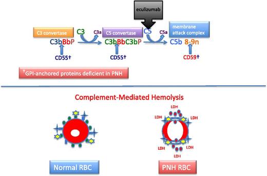 Figure 2. Complement and PNH. The hemolysis of PNH is due to aberrant regulation of the APC. The APC is a component of the innate immune system. Unlike the classical pathway of complement that requires a recognition factor such as antibody to activate the pathway, the APC is continuously active. Therefore safeguards have evolved to protect host cells against APC-mediated injury. In the case of erythrocytes, 2 GPI-APs, CD55 and CD59, serve this function. Two enzymatic convertases amplify the activity of the APC (top). The C3 convertase consists of activated C3 (C3b), activated factor B (Bb, the enzymatic subunit of the complexes that is proteolytically activated by factor D, a trace plasma protein that may be activated by 1 of the mannose-binding lectin-associated serine proteases), and factor P (formerly called properdin). Factor P stabilizes the C3 convertase, allowing each convertase to activate many molecules of C3, and in the process, generate the weak anaphylatoxin, C3a. The C5 convertase is similar in structure to the C3 convertase except that 2 molecules of C3b are required to position C5 for cleavage by activated factor B (Bb). Many molecules of C5 are cleaved by the C5 convertase, and this process generates many molecules of the potent anaphylatoxin and neutrophil chemo-attractant, C5a. Activated C5 (C5b) is the nidus for formation of the MAC of complement consisting of C5b, C6, C7, C8, and multiple molecules of C9. The MAC inserts into the lipid bilayer of the cell, forming a transmembrane torus that results in osmotic lysis. CD55 (DAF) blocks the formation and stability of both the C3 and C5 convertases, whereas CD59 (MIRL) blocks formation of the cytolytic MAC, primarily by inhibiting binding and multiplicity of C9. Eculizumab is a humanized monoclonal anti-C5 antibody that prevents activation of C5 by the C5 convertase. Consequently, the MAC cannot form (and C5a is not generated), accounting for the inhibition of the intravascular hemolysis of PNH. However, eculizumab does not inhibit formation of the C3 convertase, accounting for the opsonization by activation and degradation products of C3 observed in patients with PNH treated with eculizumab. Normal RBCs are protected against APC-mediated injury (black crosses represent APC C3 and C5 convertase formation; yellow stars represent MAC formation) by CD55 (blue ovals) and CD59 (green ovals) (bottom). PNH cells lacking the complement inhibitory proteins CD55 and CD59 undergo complement-mediated lysis, releasing cellular contends including hemoglobin (red circles) and LDH into the plasma.
