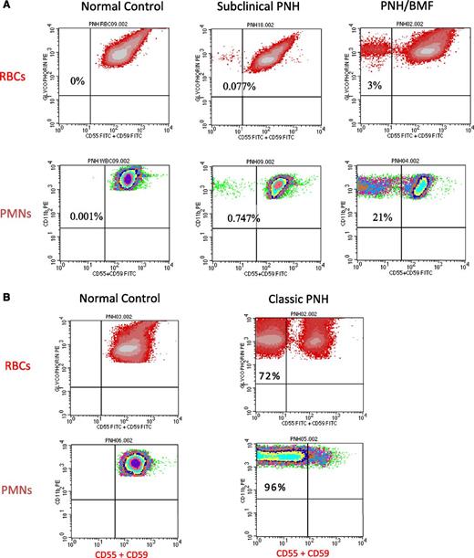 Figure 3. Flow cytometry of peripheral blood cells from patients with either subclinical PNH, PNH/bone marrow failure (BMF), or classic PNH. (A) In these examples, 2-color flow cytometry is used to analyze RBCs (top) and neutrophils (PMNs) (bottom). RBCs are gated on based on staining with phycoerythrin (PE)-conjugated anti-glycophorin, and GPI-APs are gated on using a combination of fluorescein isothiocyanate–conjugated anti-CD55 and anti-CD59. Neutrophils (PMNs) (bottom) are gated on using PE-conjugated anti-CD11b. (Left, top and bottom) Analysis of RBCs and PMNs from a normal volunteer (control). All the normal RBCs and PMNs express CD55 and CD59. Patients with subclinical PNH (middle) have very small clones, typically less than 1% (middle), and they have no biochemical evidence of hemolysis. Patients with PNH/BMF (right) have at least biochemical evidence of hemolysis, but clone size is generally relatively small. In the case illustrated, the clone size of 21% is at the lower limit for biochemical detection of hemolysis. (B) (Right, top and bottom) Analysis of RBCs and PMNs from a patient with classic PNH. The percentage of cells that are deficient in expression of GPI-APs is shown the inner-upper quadrant of the histograms. The percentage of deficient RBCs is invariably greater than the percentage of deficient PMNs because GPI-AP–deficient RBCs are selectively destroyed by complement-mediated lysis, whereas GPI-AP–deficient PMNs have a normal life span. For this reason, the size of the PNH clone is determined by the percentage of GPI-AP–deficient PMNs rather than by the percentage of GPI-AP–deficient RBCs.
