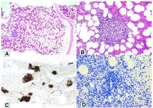 Figure 1. Cold agglutinin–associated lymphoproliferative bone marrow disease. Bone marrow trephine biopsy showing intraparenchymatous nodular lymphoid lesions (A-B, hematoxylin and eosin staining, original magnification ×40 and ×200, respectively). Immunoperoxidase staining for CD20 highlights intraparenchymatous nodular B-cell infiltration (C, original magnification ×200). Mast cells are not discerned around the nodular lymphoid lesions (D, Giemsa staining, original magnification ×200). Reprinted from Randen et al4 with permission.