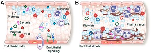 Figure 2. Platelet activation, homotypic and heterotypic binding to other platelets and leukocytes, and sequestration of platelets and myeloid leukocytes within thrombi are common complications of septic syndromes in humans. Pathogens, pathogen-derived factors, or agonists present in the septic milieu (A) induce platelet activation and aggregation, signaling to areas of injured or inflamed endothelium, and (B) orchestrating deposition of fibrin, platelets, and myeloid leukocytes within micro- and macrovascular thrombi (modified from Rondina et al.8). In the figure, platelets are indicated as blue, irregularly- or spherically-shaped cells.