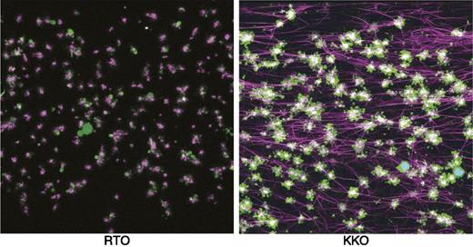Figure 2. Visualization of thrombus formation by a HIT-like monoclonal antibody. Confocal microscopy images of fixed thrombi formed in human whole blood perfused with a control antibody (RTO) or a HIT-like antibody (KKO), and PF4. Platelet aggregates are shown in green, fibrin fibers visualized by adding of Alexa 647-labeled fibrinogen are purple, and white blood cells are shown in cyan (overlap of blue nuclear dye is Hoechst and green is calcein AM). The attachment points of fibrin to platelets are white because of the superposition of purple and green colors. Reprinted from Tutweiler et al10 with permission.