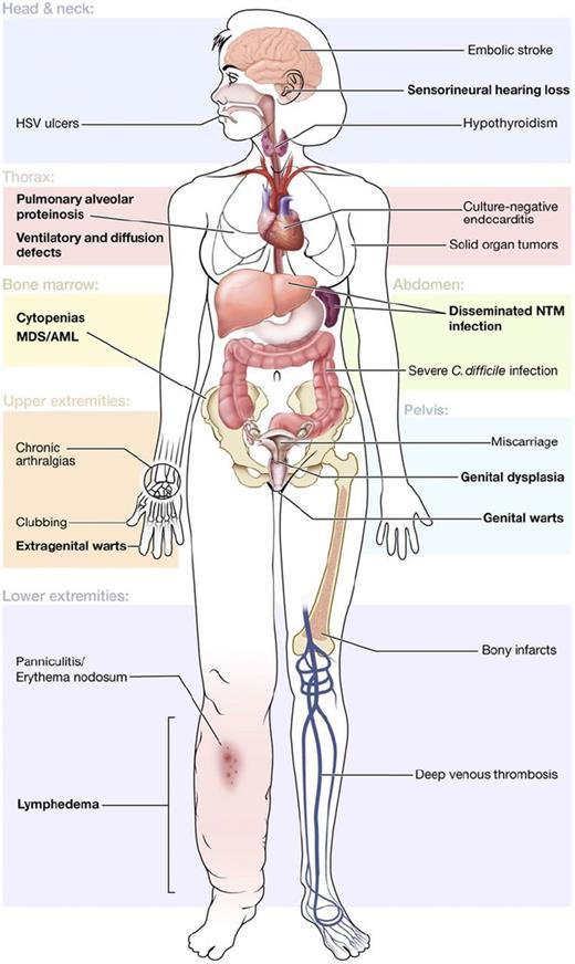 Figure 1. Clinical features of GATA2 deficiency. Common manifestations are shown by organ system, with primary features in bold. Reprinted from Spinner et al.19 C difficile, Clostridium difficile; HSV, herpes simplex virus; NTM, nontuberculous mycobacteria.