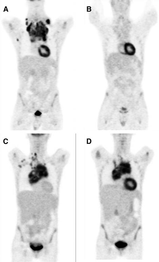 Figure 1. FDG-PET interim scans demonstrating negative and positive results. (A, C) Presentation scans showing uptake by HL. (B) Negative interim PET scan showing only physiological FDG uptake. (D) Positive interim PET scan showing residual uptake in the mediastinum.