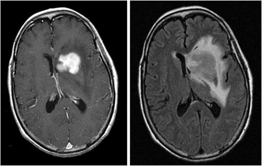 Figure 1. Magnetic resonance images from a patient with PCNSL. A T1-weighted, axial, postcontrast scan (left) demonstrates intense, homogenous enhancement of the tumor in the region of the left caudate nucleus. An axial T2/FLAIR scan at the same anatomical level (right) demonstrates hyperintense signal surrounding the tumor, reflecting vasogenic cerebral edema. (Courtesy Priscilla K. Brastianos, M.D.)