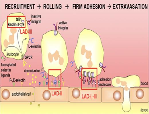 Figure 2. Leukocyte recruitment and defects in LAD. Leukocytes migrate to the site of inflammation after a gradient of chemoattractants. The cells slow down within the vasculature because of transient interactions between selectins and their glycosylated ligands, which are defective in LAD-II. Next, stable adhesion by leukocyte integrins, absent in LAD-I, to ligands on the endothelium results in leukocyte arrest. Activation of blood cell integrins is decreased in LAD-III. Normal neutrophils extravasate into tissues after firm adhesion. From van de Vijver et al,50 with permission.