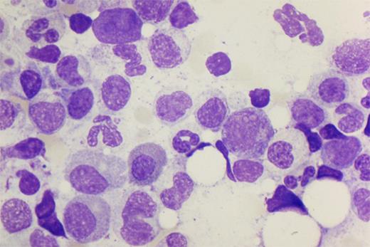 Figure 1. Bone marrow aspirate specimen from human immunodeficiency virus–infected patient with PRCA as a result of parvovirus. Giant pronormoblasts near the center of the field (100×).