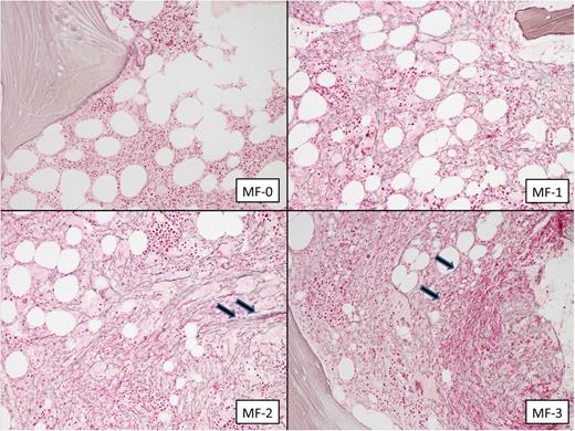 Figure 3. Illustrations of BM reticulin fibers and osteosclerosis. MF-0: scattered linear reticulin fibers with no intersections (internal control is represented by the reticulin fiber around the vessel; MF-1: loose network of reticulin fibers with many intersections, especially in perivascular areas; MF-2: diffuse and dense increase in reticulin fibers, with extensive intersections and occasionally with focal bundles of collagen (arrows); and MF-3: diffuse and dense increase in reticulin fibers, with extensive intersections and coarse bundles of collagen (arrows).