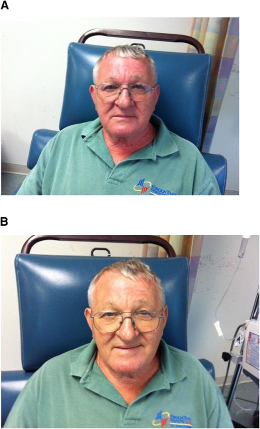 Figure 2. (A) Minor infusion reaction. (B) After (used with patient’s permission).