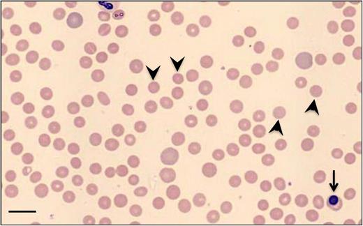 Figure 1. Blood smear of a patient with w-AIHA on presentation. Polychromasia reflecting reticulocytosis, many microspherocytes (few pointed by arrowheads), and a nucleated red blood cell (arrow), indicating stress erythropoiesis, are noted (Wright-Giemsa stain). Bar represents 14 μm.